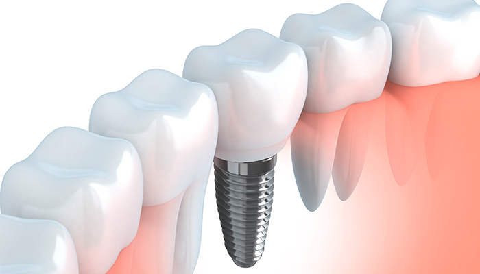 Implante dental: procedimiento y ventajas