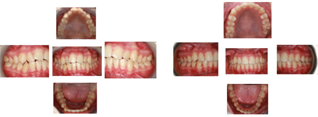 dientes torcidos antes y despues
