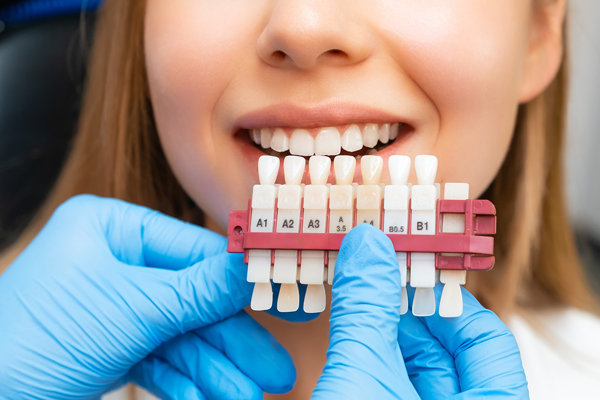 Carillas dentales de composite: sus ventajas y desventajas