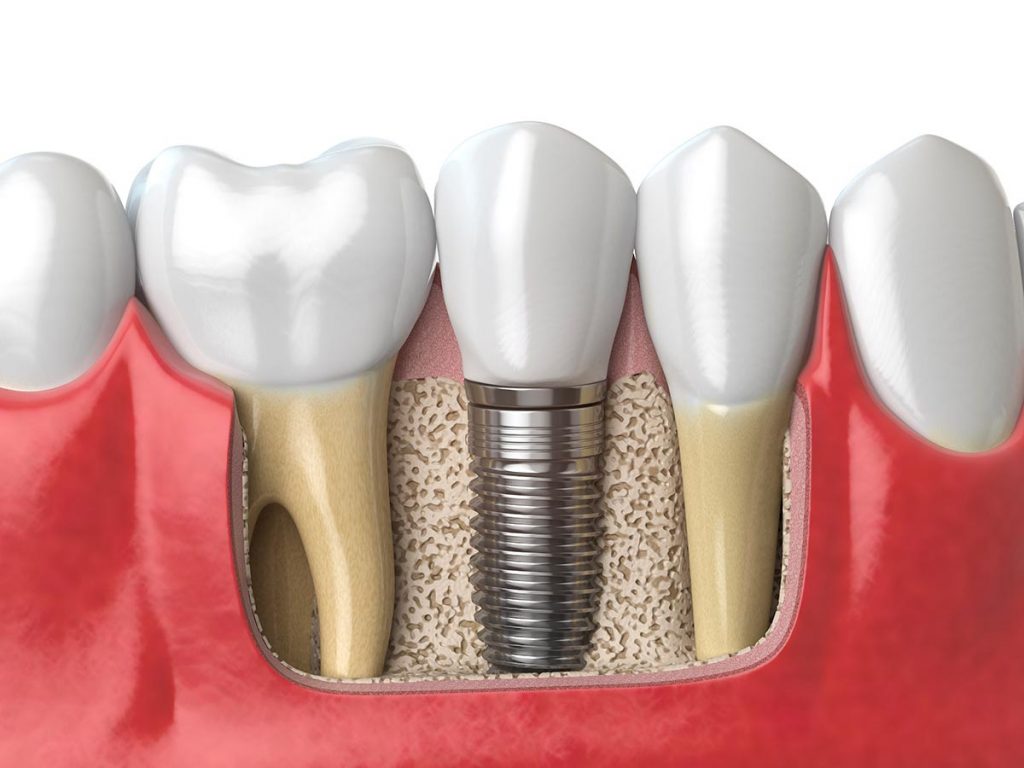 tipos de coronas para implantes dentales