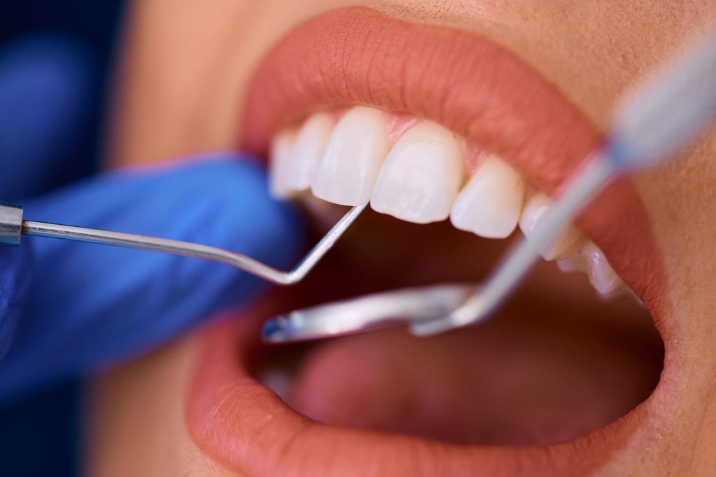 curetaje dental