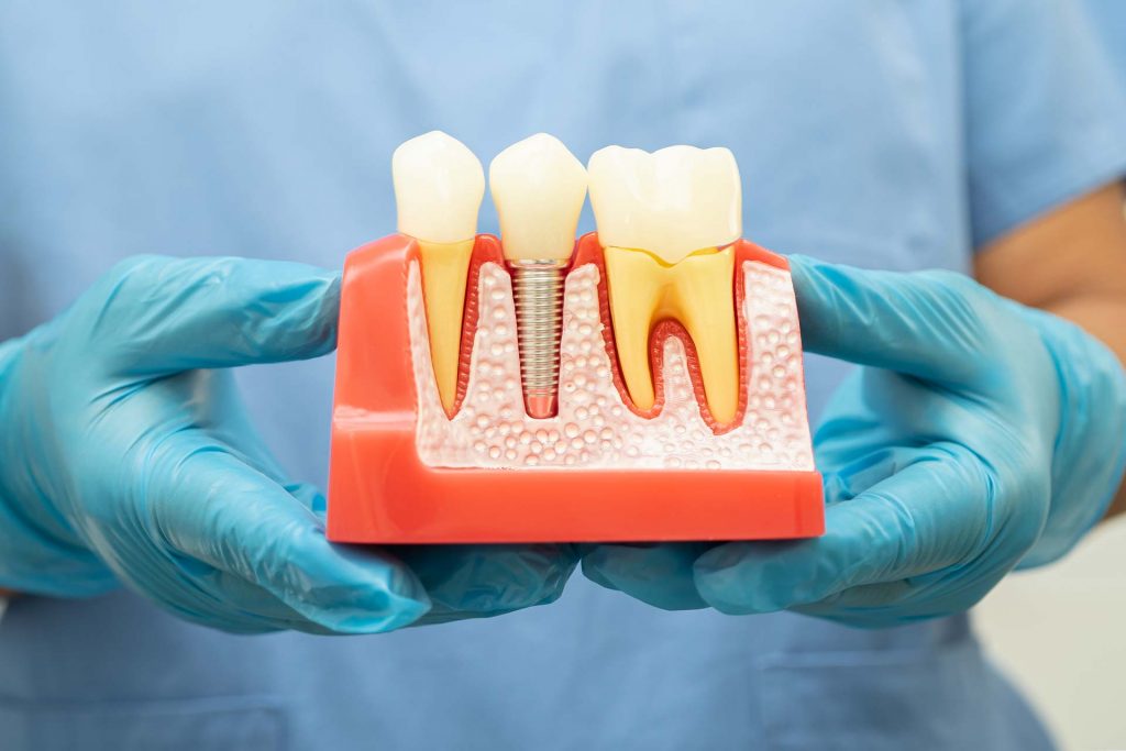 implantes dentales sin cirugia
