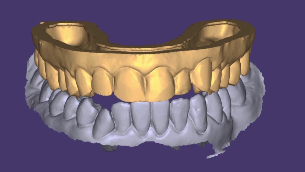 diseno de sonrisa antes