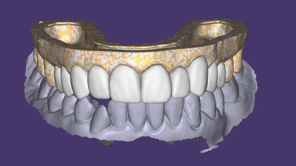 diseno de sonrisa despues