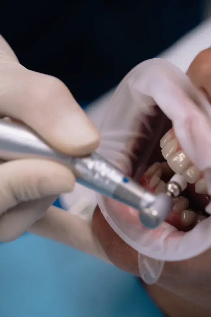 tratamiento gingivitis zaragoza