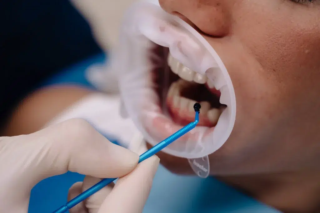 tratamiento gingivitis zaragoza